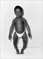 Young African American child with disabled legs, Atlanta, Georgia, February 18, 1952.